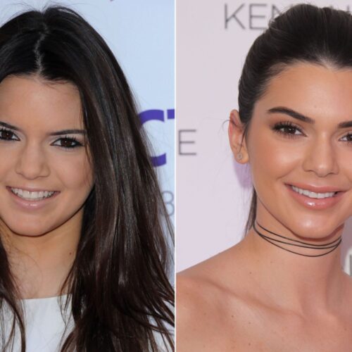 Kendall Jenner Before & After Plastic Suregry