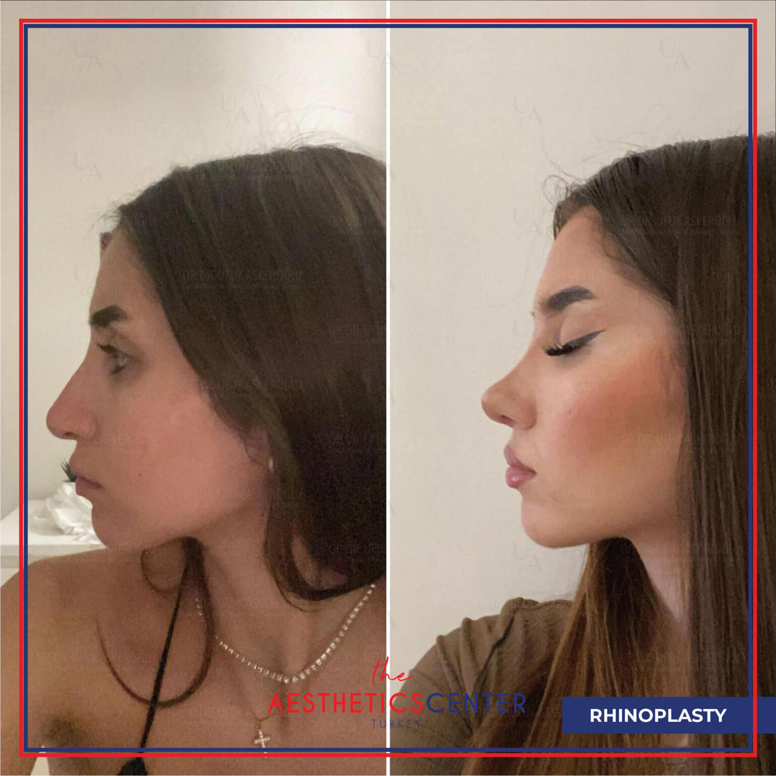 Nose Job PostOp Turkey Aesthetic Center Turkey