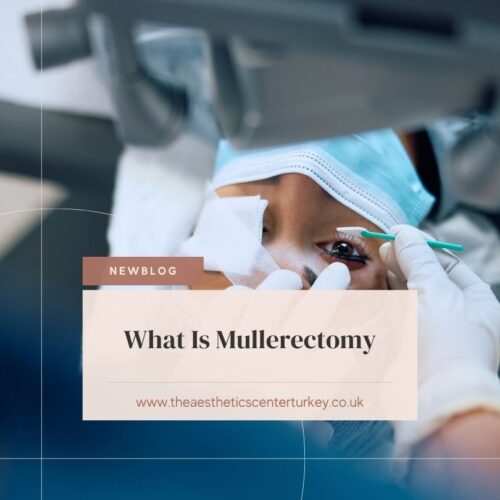 What Is Mullerectomy